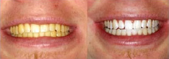 pro_teeth_whitening BEFORE AFTER