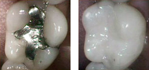 tooth_colored_fillings