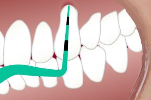 periodontal therapy